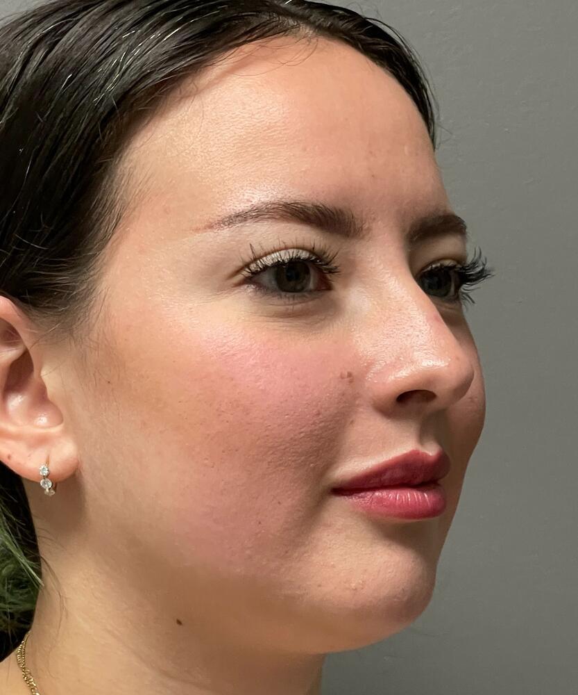 Rhinoplasty Before & After Image